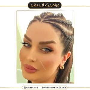 جراحی-بینی-433