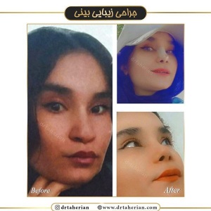 جراحی-بینی-434