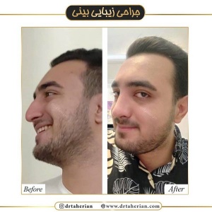 جراحی-بینی-437