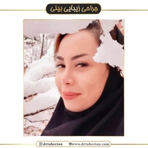 جراحی-بینی-438