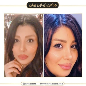 جراحی-بینی-439