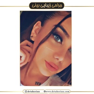 جراحی-بینی-442