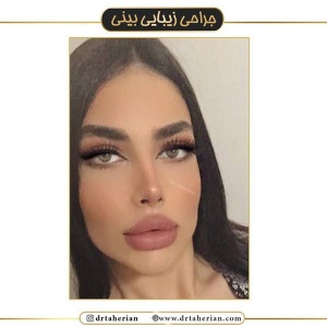 جراحی-بینی-443