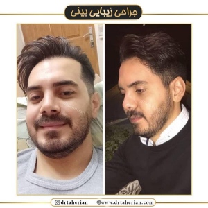 جراحی-بینی-446