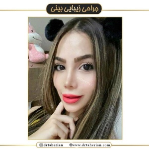 جراحی-بینی-447