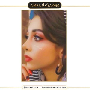 جراحی-بینی-448