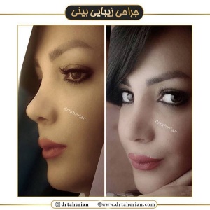 جراحی-بینی-449