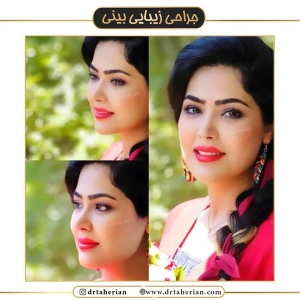 جراحی-بینی-451