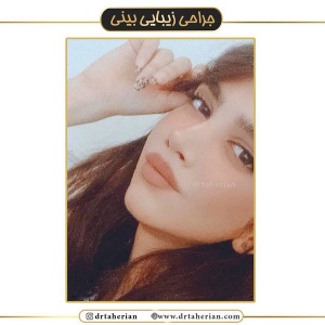 جراحی-بینی-452