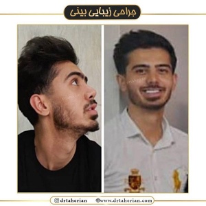 جراحی-بینی-453