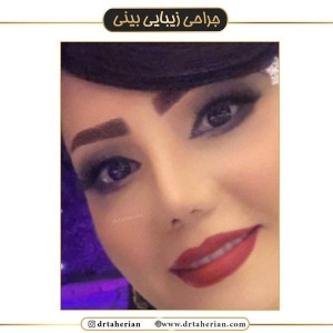 جراحی-بینی-454