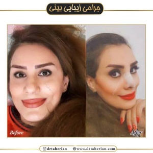 جراحی-بینی-455