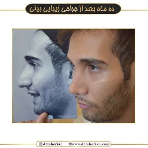 جراحی-بینی-457