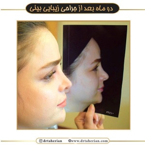 جراحی-بینی-458