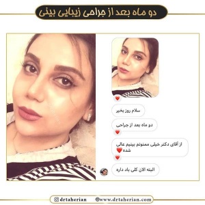 جراحی-بینی-461