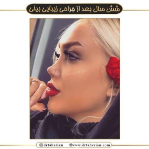 جراحی-بینی-463