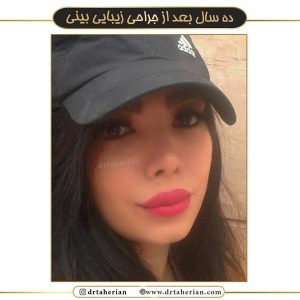 جراحی-بینی-464