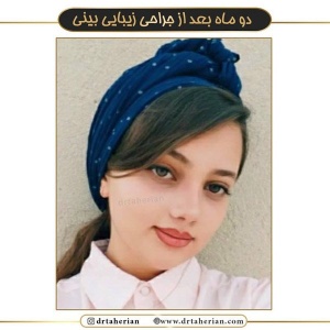 جراحی-بینی-465