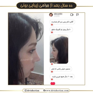 جراحی-بینی-467