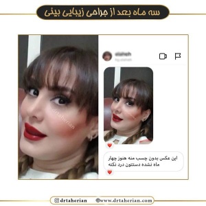 جراحی-بینی-469