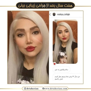 جراحی-بینی-474