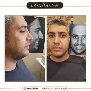 جراحی-بینی-475