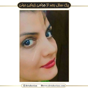 جراحی-بینی-477