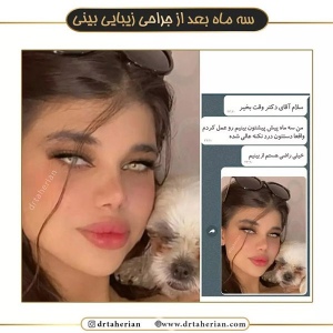 جراحی-بینی-478