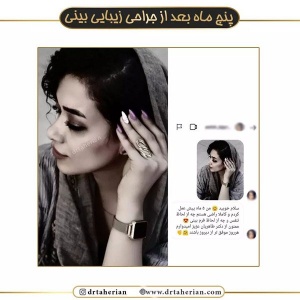 جراحی-بینی-482