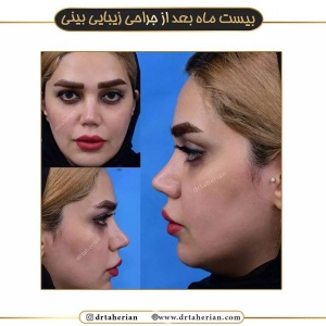جراحی-بینی-488