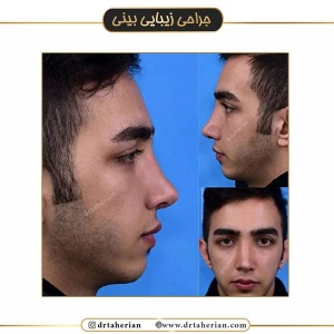 جراحی-بینی-490