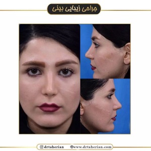 جراحی-بینی-498
