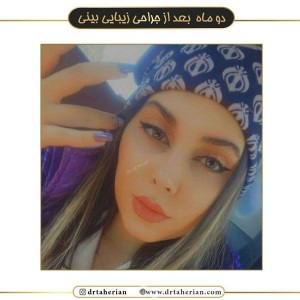 جراحی-بینی-505