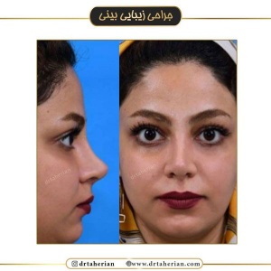جراحی-بینی-507