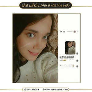 جراحی-بینی-509
