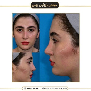جراحی-بینی-510
