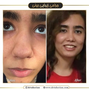 جراحی-بینی-512