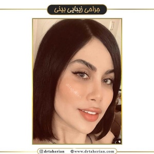 جراحی-بینی-513