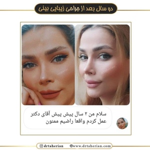 جراحی-بینی-515