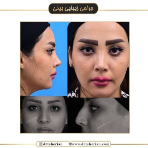 جراحی-بینی-516