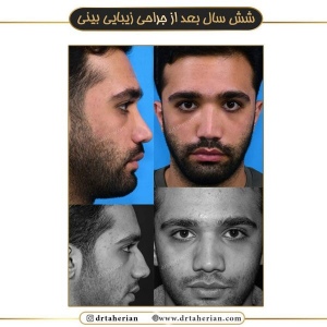 جراحی-بینی-517