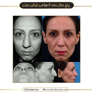 جراحی-بینی-518