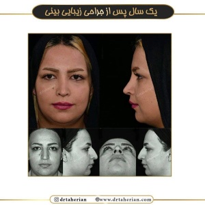 جراحی-بینی-519