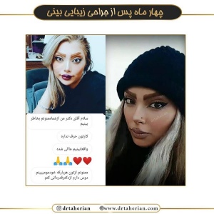 جراحی-بینی-520