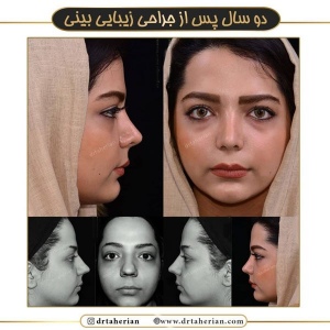 جراحی-بینی-521