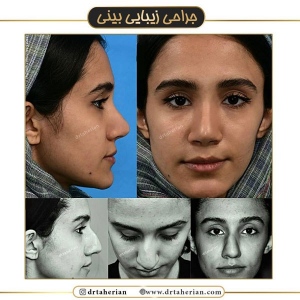 جراحی-بینی-524