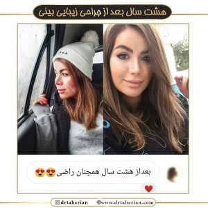 جراحی-بینی-529