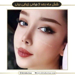 جراحی-بینی-532