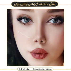 جراحی-بینی-533