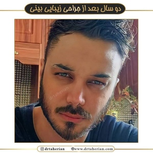 جراحی-بینی-535